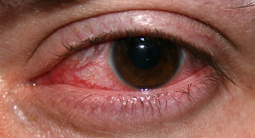 Common Eye Diseases and Prevention Methods