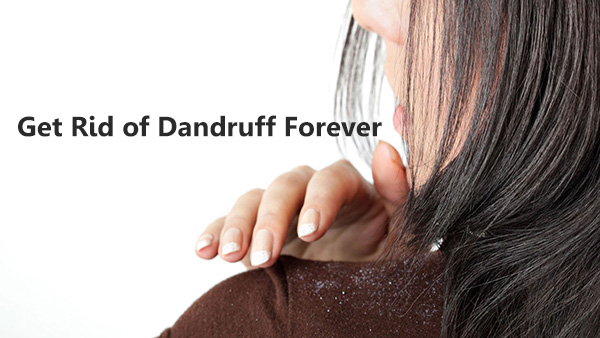 dandruff